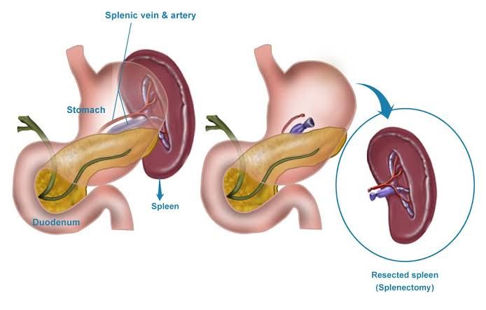PREPARING FOR A SPLENECTOMY: TIPS AND WHAT YOU SHOULD KNOW