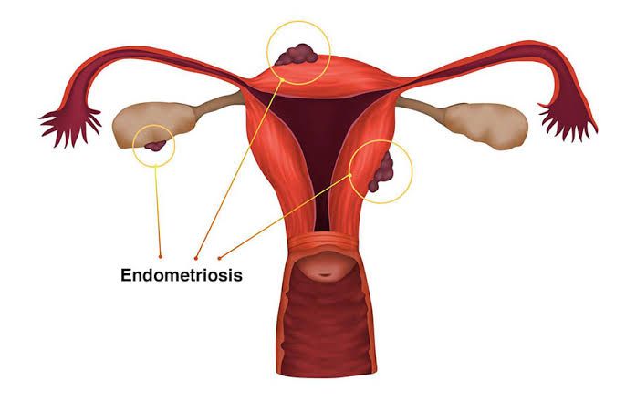 ENDOMETRIOSIS DIAGNOSIS: WHAT TO EXPECT AT YOUR APPOINTMENT ENDOMETRIOSIS DIAGNOSIS: WHAT TO EXPECT AT YOUR APPOINTMENT