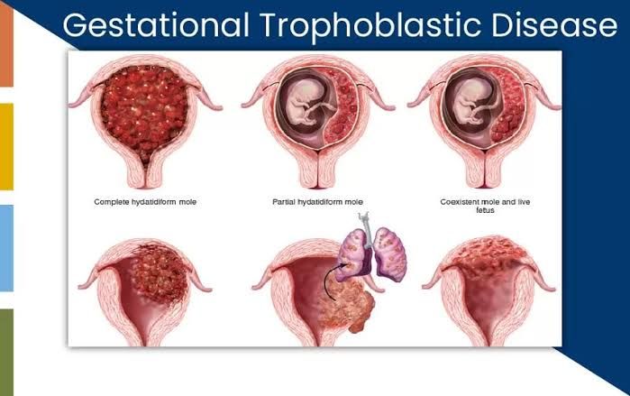 RESEARCH BREAKTHROUGHS IN GESTATIONAL TROPHOBLASTIC DISEASES
