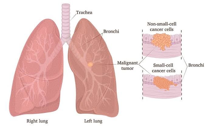 LUNG TUMORS: EARLY SIGNS YOU SHOULD KNOW