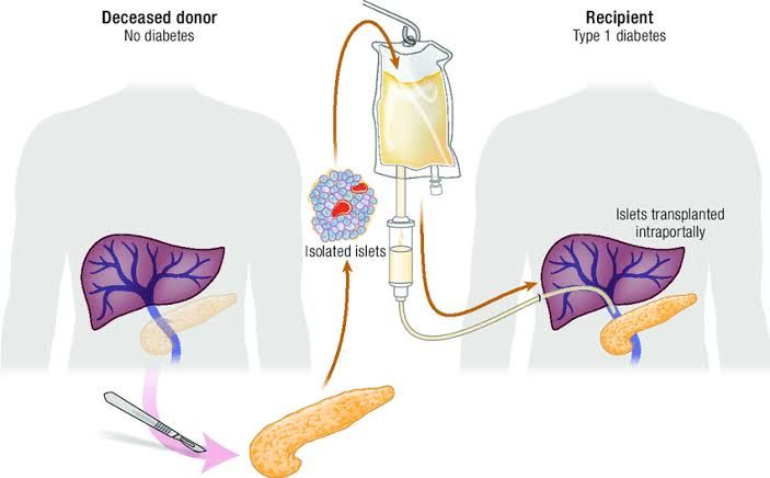 ISLET ISOLATION AND TRANSPLANTATION: BREAKTHROUGHS IN DIABETES MANAGEMENT