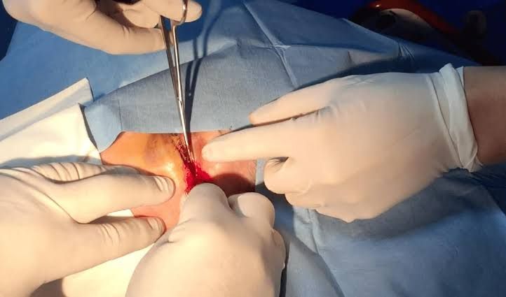 HOW TO PERFORM A LATERAL CANTHOTOMY: ESSENTIAL STEPS FOR OCULAR EMERGENCIES