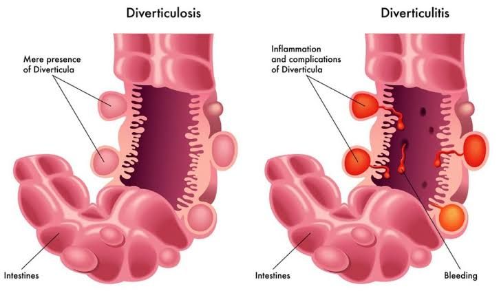 RECOGNIZING SIGNS OF DIVERTICULOSIS AND MESENTERIC ISCHEMIA
