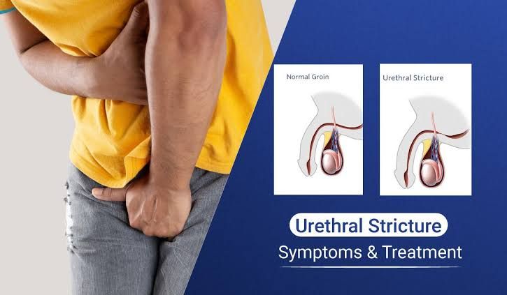 ESSENTIAL DIAGNOSTIC APPROACHES FOR URETHRAL STRICTURE INVESTIGATION