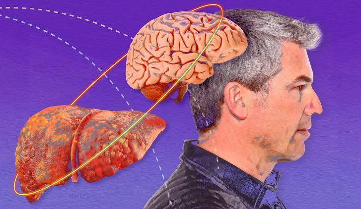 TOP STRATEGIES FOR MANAGING HEPATIC ENCEPHALOPATHY EFFECTIVELY