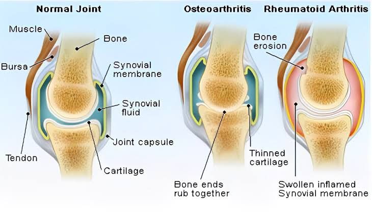 UNDERSTANDING ARTHRITIS: SYMPTOMS AND TREATMENT OPTIONS UNDERSTANDING ARTHRITIS: SYMPTOMS AND TREATMENT OPTIONS