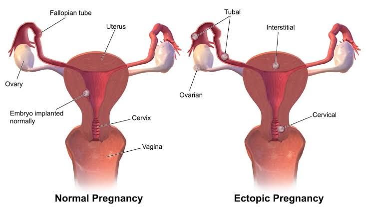THE RISING INCIDENCE OF ECTOPIC PREGNANCY: WHAT YOU NEED TO KNOW