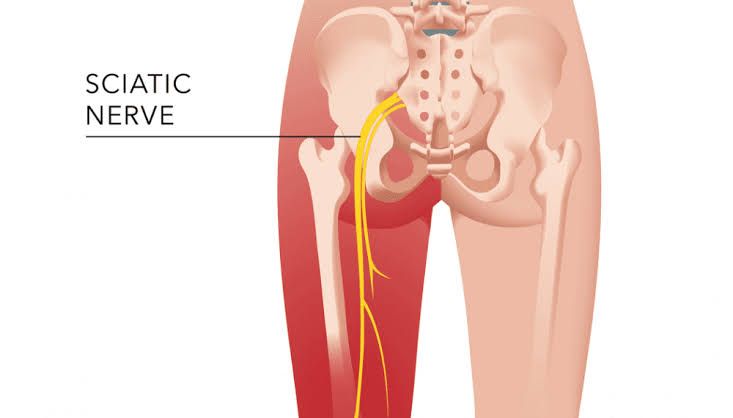 SCIATIC NERVE: COMMON MYTHS DEBUNKED