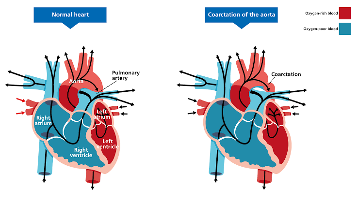 NAVIGATING COARCTATION OF THE AORTA: IN-DEPTH CLINICAL RESOURCE