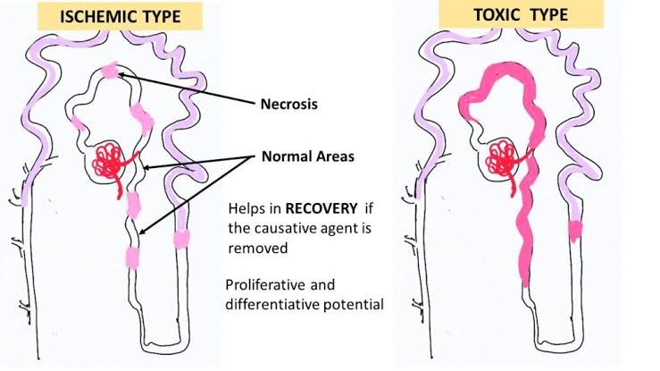 MORPHOLOGY AND DAMAGE PATTERNS IN ACUTE TUBULAR INJURY: KEY ETIOLOGICAL FACTORS