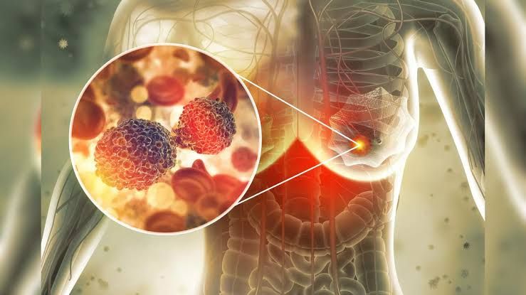 NEOPLASTIC DISEASES OF THE BREAST: A COMPREHENSIVE OVERVIEW