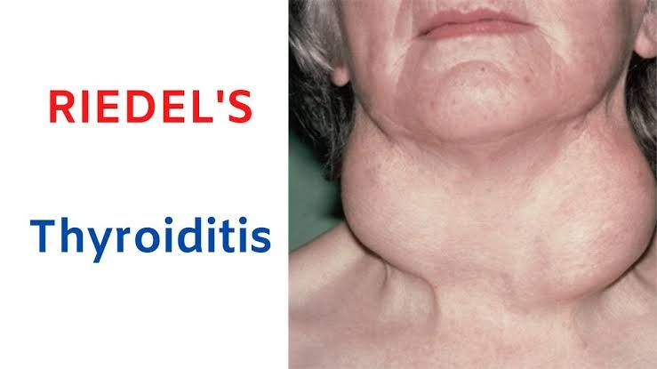 THYROID GLAND PATHOLOGY: COMMON DISEASES AND FEATURES THYROID GLAND PATHOLOGY: COMMON DISEASES AND FEATURES