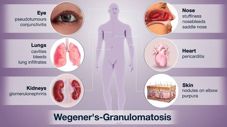 GRANULOMATOSIS WITH POLYANGIITIS: CLINICAL FEATURES, INVESTIGATIONS, MANAGEMENT, PROGNOSIS, AND COMPLICATIONS