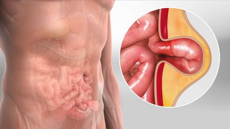 HERNIA TREATMENT OPTIONS THAT WORK BEST