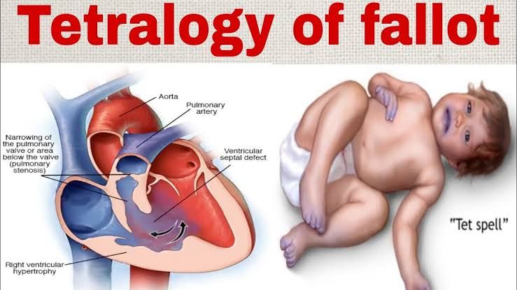 TETRALOGY OF FALLOT EXPLAINED: ETIOLOGY, SYMPTOMS, DIAGNOSIS, AND TREATMENT