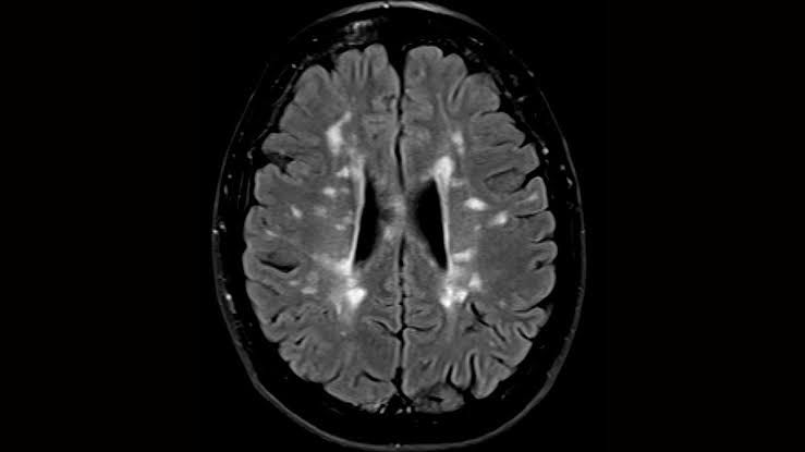 IMPROVING DIAGNOSTICS: CLINICIAN’S INSIGHT INTO BRAIN LESIONS ON CT SCANS