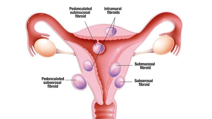 A COMPREHENSIVE GUIDE TO DIAGNOSING BENIGN TUMORS OF THE UTERINE CORPUS A COMPREHENSIVE GUIDE TO DIAGNOSING BENIGN TUMORS OF THE UTERINE CORPUS