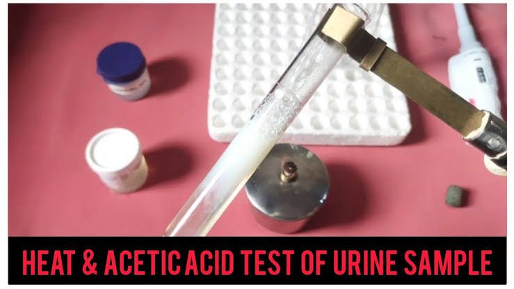 DEMONSTRATING THE PRINCIPLE OF PROTEIN DETECTION BY HEAT METHOD IN URINE
