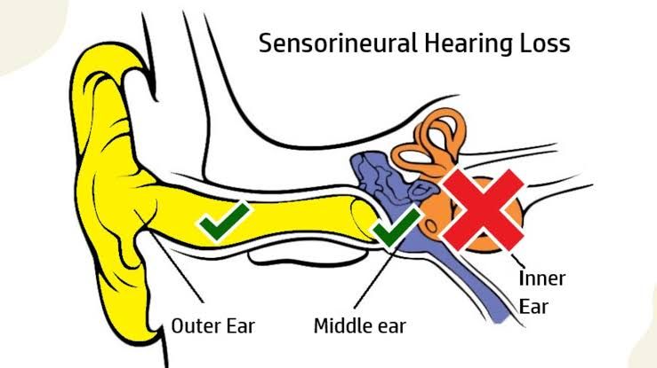 EFFECTIVE APPROACHES TO MANAGING SENSORINEURAL HEARING LOSS IN PATIENTS