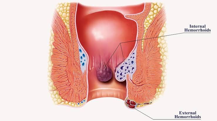 ACUTE PERIANAL CONDITIONS ACUTE PERIANAL CONDITIONS