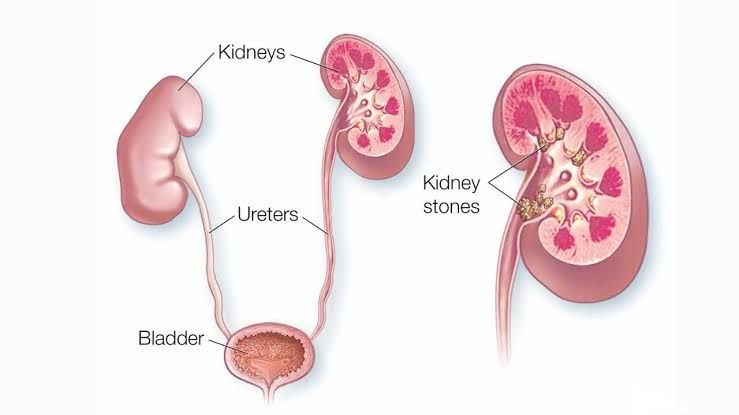 DECODING UROLITHIASIS: INSIGHTS INTO STONE FORMATION AND PATHOLOGICAL IMPACT