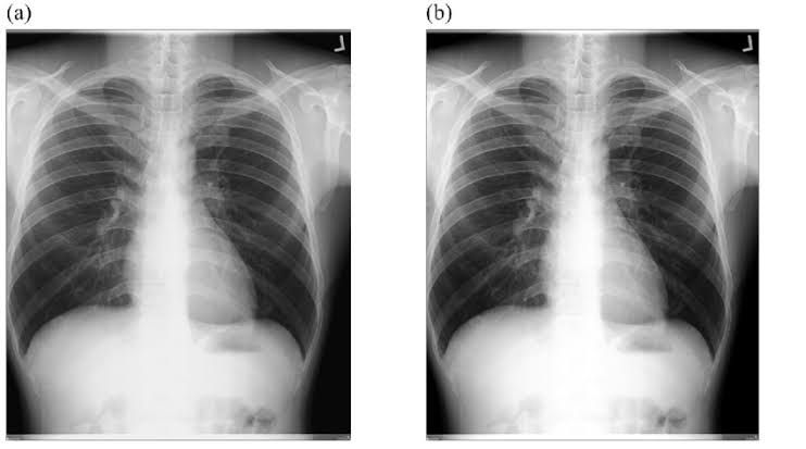 HOW THE HIGH KV METHOD IMPROVES X-RAY IMAGES
