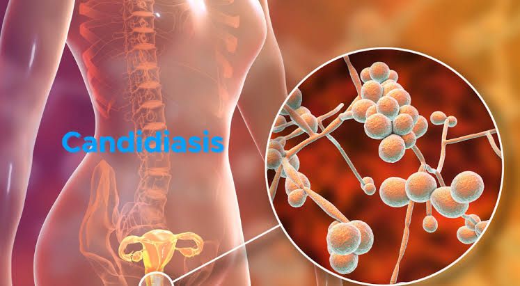 CANDIDIASIS EXPLAINED: RISK FACTORS AND SOLUTIONS CANDIDIASIS EXPLAINED: RISK FACTORS AND SOLUTIONS