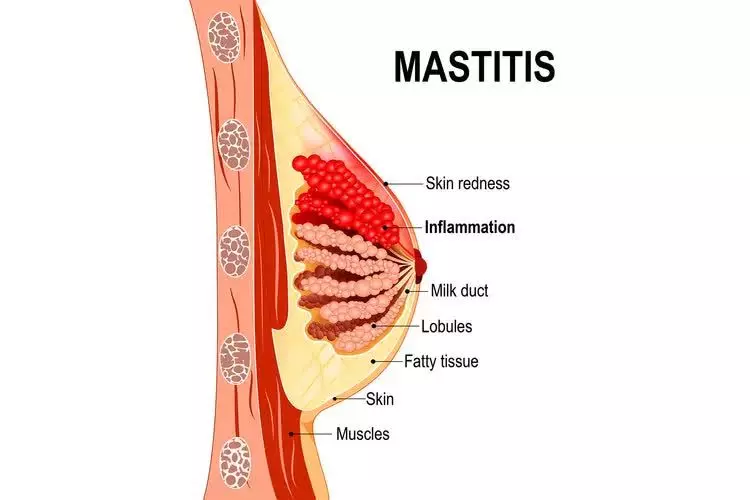 MASTITIS IN OBSTETRICS: CAUSES, SYMPTOMS, AND TREATMENT OPTIONS