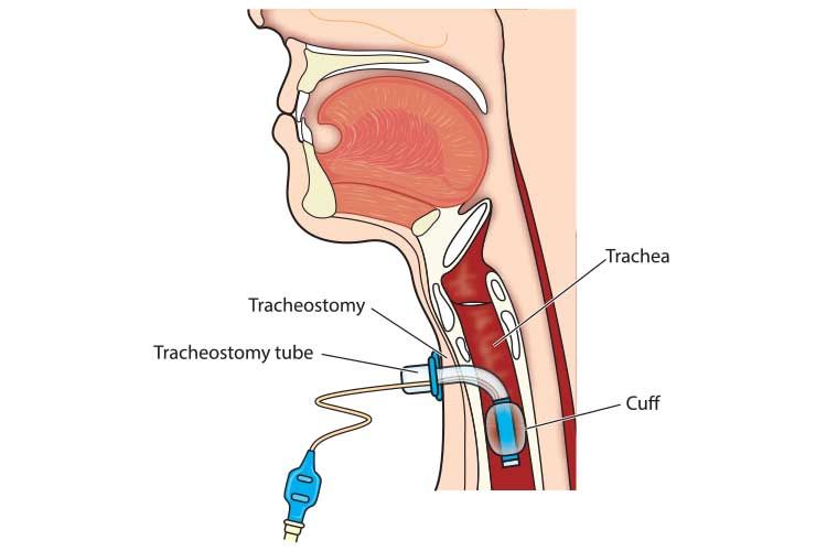 EPISTAXIS, FACIAL TRAUMA STRIDOR AND TRACHEOSTOMY EPISTAXIS, FACIAL TRAUMA STRIDOR AND TRACHEOSTOMY