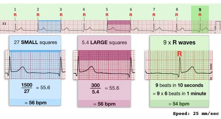 ECG RATE AND RHYTHM: KEY INDICATORS FOR EMERGENCY CARDIAC CARE
