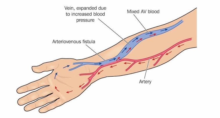 PREREQUISITES FOR SUCCESSFUL VASCULAR ACCESS: A COMPREHENSIVE GUIDE