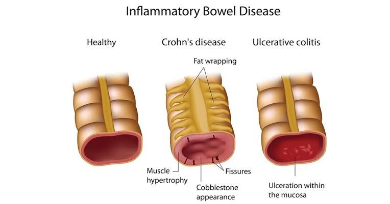COLORECTAL DISEASES: SYMPTOMS, DIAGNOSIS AND TREATMENT OPTIONS COLORECTAL DISEASES: SYMPTOMS, DIAGNOSIS AND TREATMENT OPTIONS
