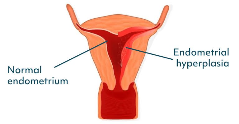 PATHOPHYSIOLOGY OF ENDOMETRIAL HYPERPLASIA AND DYSFUNCTIONAL UTERINE BLEEDING PATHOPHYSIOLOGY OF ENDOMETRIAL HYPERPLASIA AND DYSFUNCTIONAL UTERINE BLEEDING