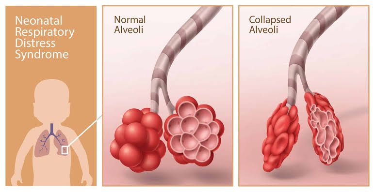 TOP STRATEGIES FOR MANAGING NEONATAL RESPIRATORY DISTRESS SYNDROME