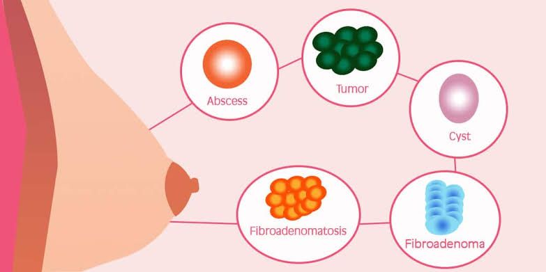 COMMON BENIGN BREAST DISORDERS YOU SHOULD KNOW