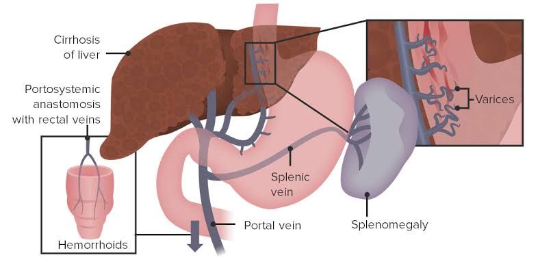 CAUSES AND SYMPTOMS OF PORTAL HYPERTENSION EXPLAINED