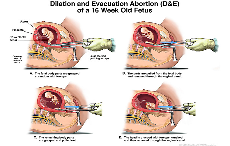 UNDERSTANDING PREGNANCY TERMINATION: ESSENTIAL INSIGHTS FOR MEDICAL EXPERTS
