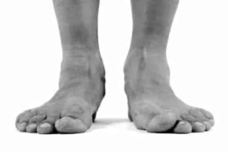 flat feet - Dynamic Podiatry