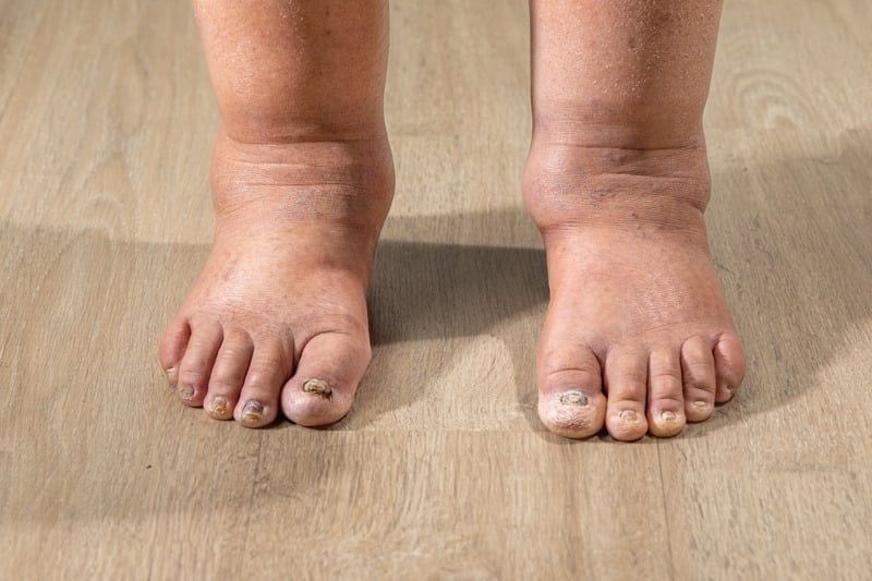 EDEMA EXPLAINED: IN-DEPTH LOOK AT ITS DEFINITION AND PATHOPHYSIOLOGY