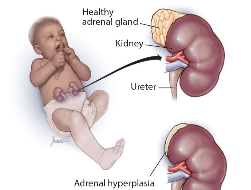 ADRENOGENITAL SYNDROME: ETIOLOGY, CLINICAL FEATURES, DIAGNOSTIC WORKUP, AND MANAGEMENT