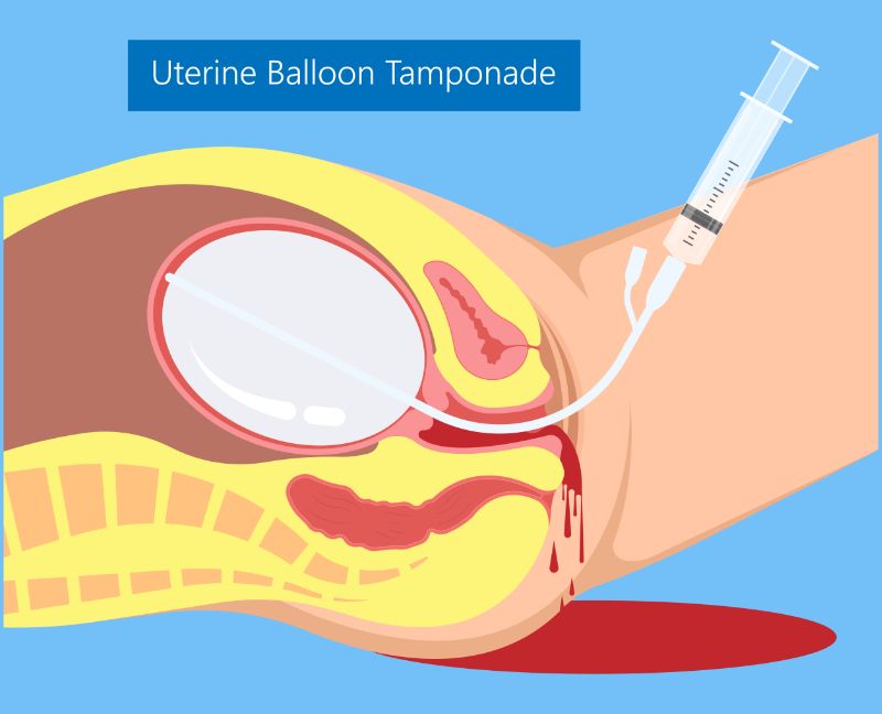 HOW UTERINE BALLOON TAMPONADE CAN SAVE LIVES IN POSTPARTUM HEMORRHAGE CASES