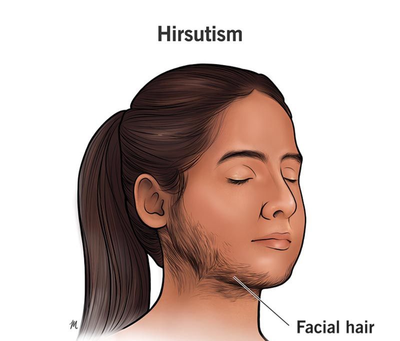 EXPLORING THE DEPTHS OF HIRSUTISM