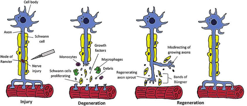 NERVE DEGENERATION: GET THE FACTS HERE NERVE DEGENERATION: GET THE FACTS HERE
