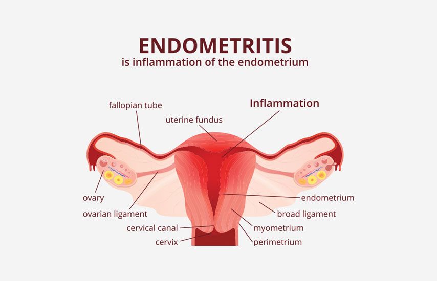 YOUR ULTIMATE RESOURCE ON POSTPARTUM ENDOMETRITIS: PREVENTION AND TREATMENT TIPS