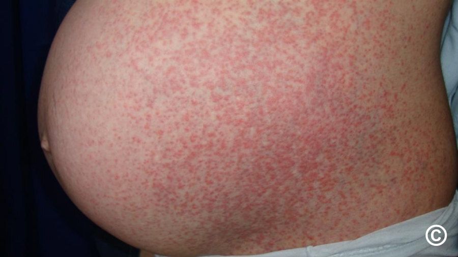 ETIOLOGY, DIAGNOSIS, AND MANAGEMENT OF POLYMORPHIC ERUPTION OF PREGNANCY