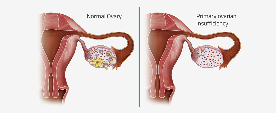 PRIMARY OVARIAN INSUFFICIENCY EXPLAINED: SYMPTOMS, CAUSES, AND TREATMENT