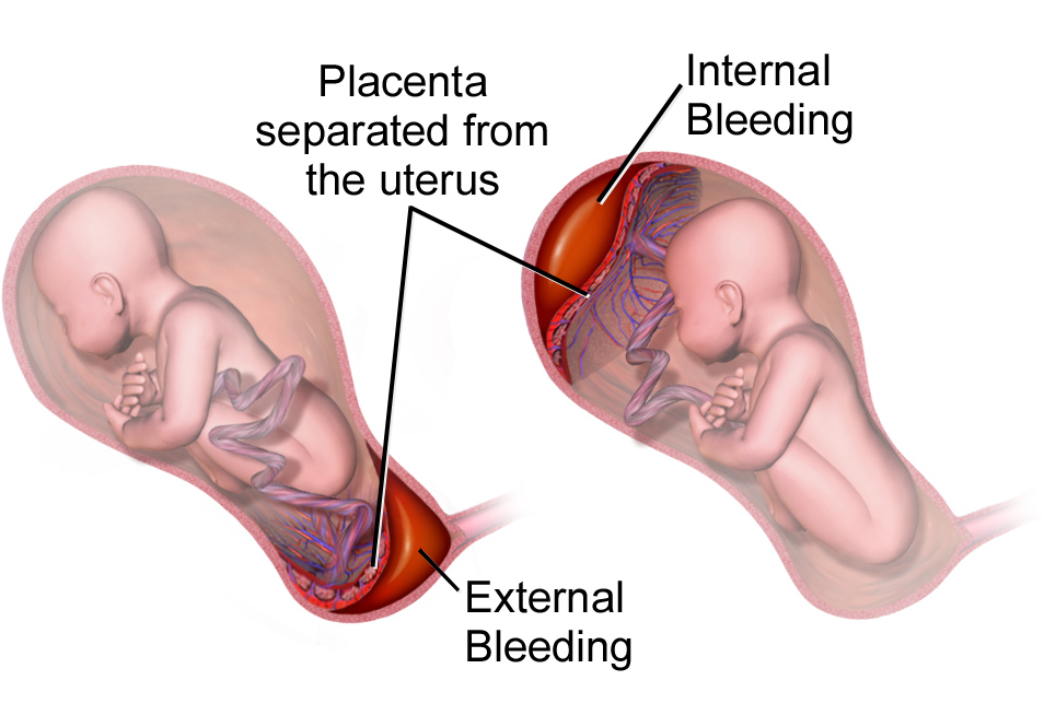 PLACENTAL ABRUPTION: WHY PROMPT MEDICAL ATTENTION IS CRUCIAL