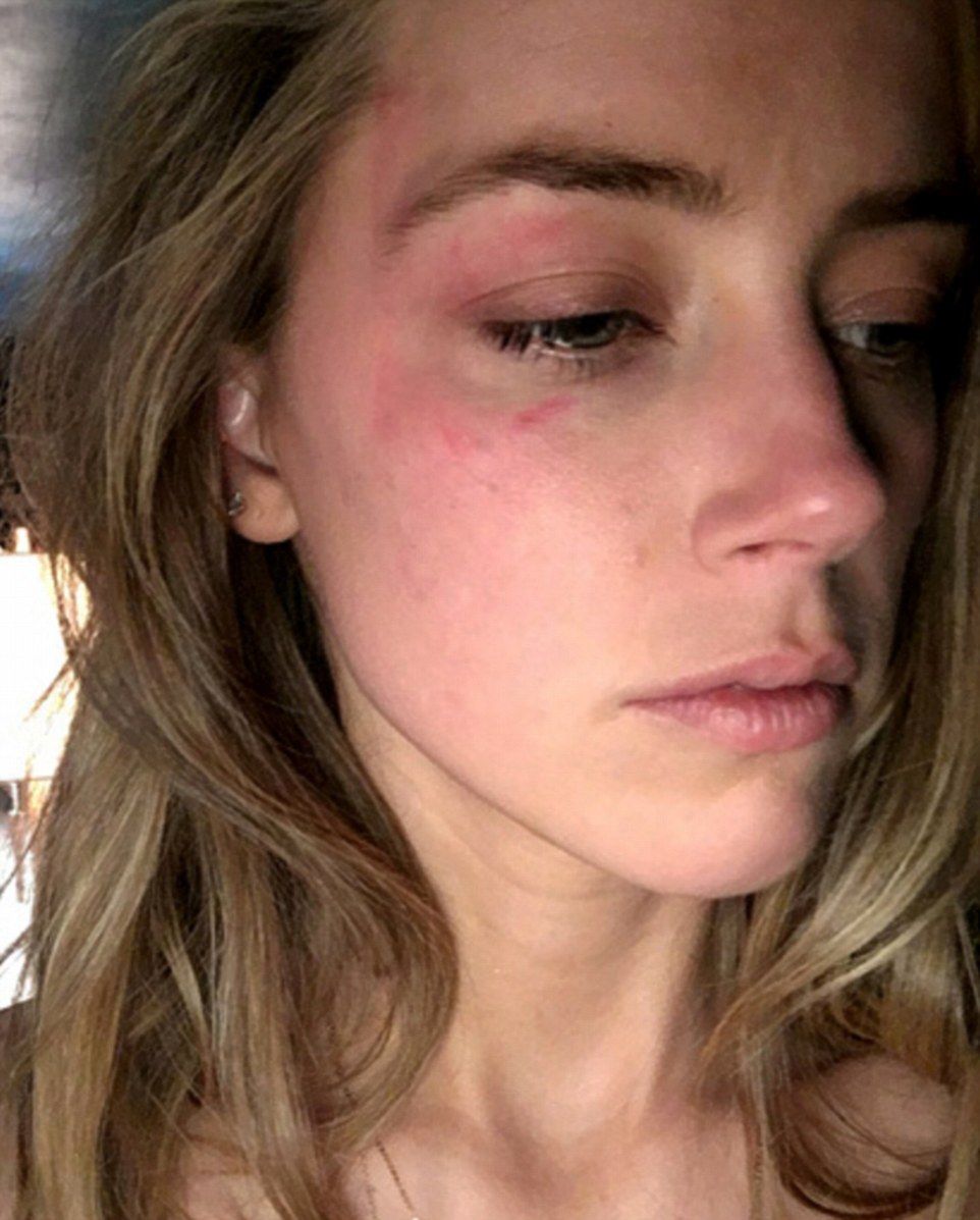 34B3A5A200000578-3613134-The_actress_submitted_a_photo_of_a_large_bruise_around_her_eye_a-a-79_1464379672313
